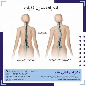 انحراف ستون فقرات