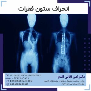 انحراف ستون فقرات