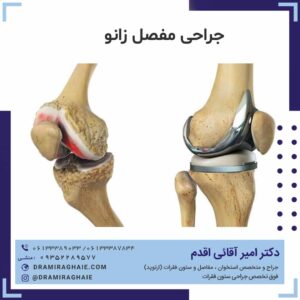 جراحی مفصل زانو