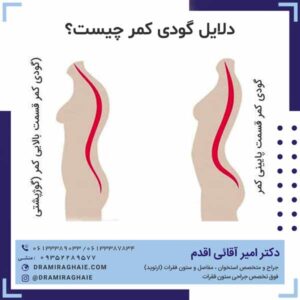 دلایل گودی کمر چیست؟