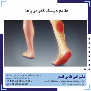 علائم دیسک کمر در پاها