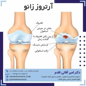 آرتروز زانو