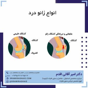 انواع زانو درد