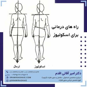 راه های درمانی برای اسکولیوز