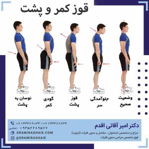 قوز کمر و پشت