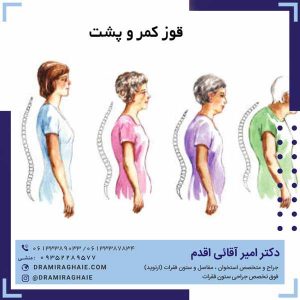 قوز کمر و پشت