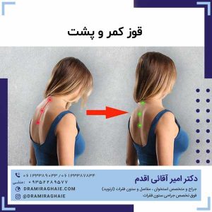 قوز کمر و پشت