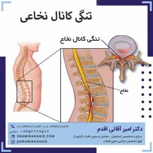 تنگی کانال نخاعی