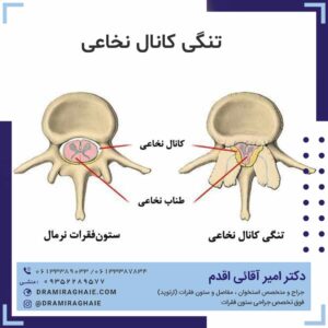 تنگی کانال نخاعی