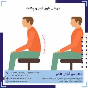 درمان قوز کمر و پشت