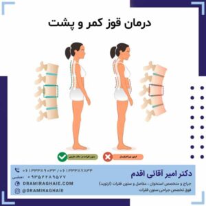 درمان قوز کمر و پشت