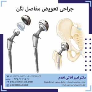 جراحی تعویض مفاصل لگن