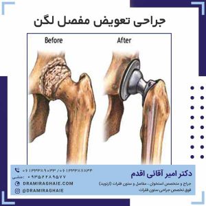 جراحی تعویض مفاصل لگن