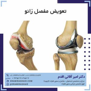تعویض مفصل زانو