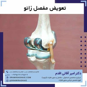 تعویض مفصل زانو