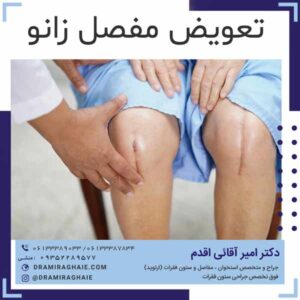 تعویض مفصل زانو
