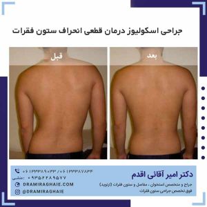 جراحی اسکولیوز درمان قطعی انحراف ستون فقرات