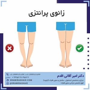 زانوی پرانتزی