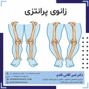 زانوی پرانتزی