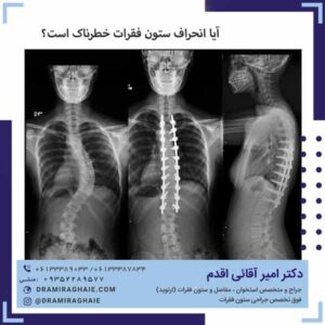 آیا انحراف ستون فقرات خطرناک است؟