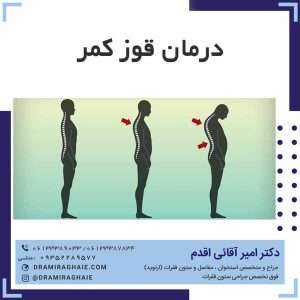 درمان قوز کمر