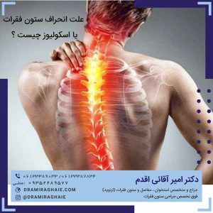 علت انحراف ستون فقرات یا اسکولیوز چیست ؟