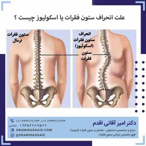 علت انحراف ستون فقرات یا اسکولیوز چیست ؟