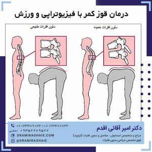 درمان قوز کمر با فیزوتراپی و ورزش