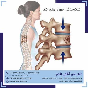 شکستگی مهره های کمر