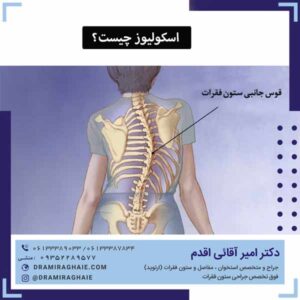اسکولیوز چیست؟