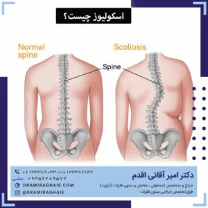 اسکولیوز چیست؟