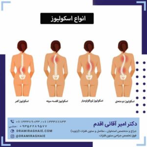 انواع اسکولیوز
