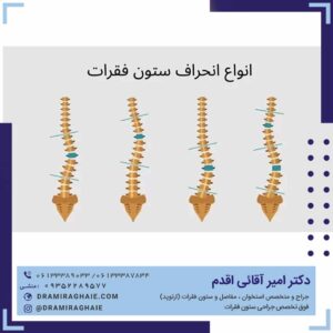 انواع اسکولیوز