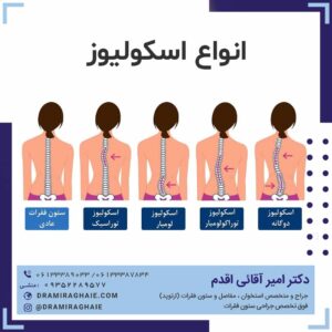 انواع اسکولیوز