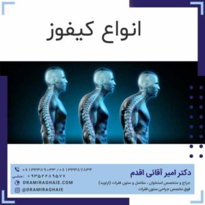 انواع کیفوز