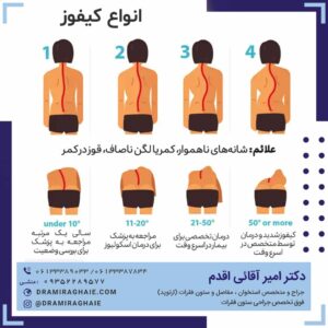 انواع کیفوز