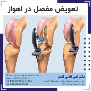 تعویض مفصل در اهواز