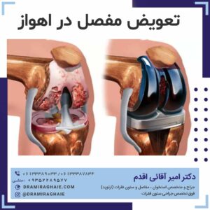 تعویض مفصل در اهواز