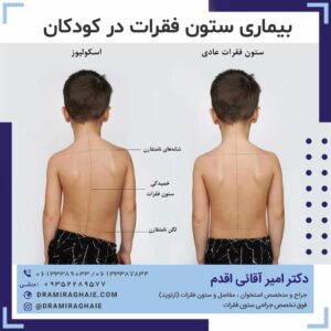 بیماری ستون فقرات در کودکان